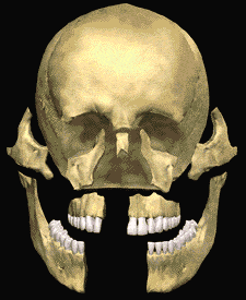 Animation of a skull with facial trauma